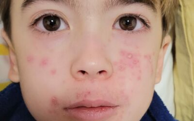 Eczema y Psoriasis